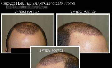 Hair transplantation surgery before and after pictures