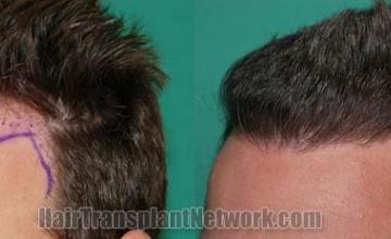 Hair transplantation surgery before and after photos