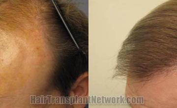 Hair restoration procedure before and after pictures