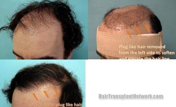 Hair transplantation surgery before and after pictures