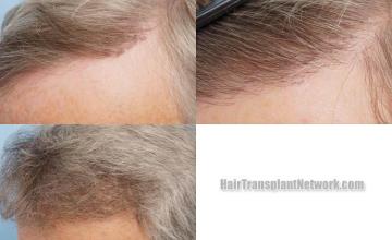 Hair transplantation surgery before and after images