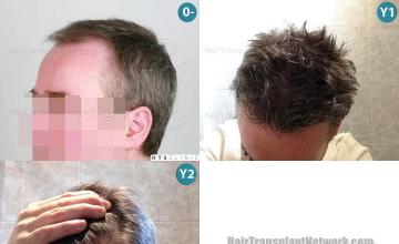 Hair transplantation surgery before and after photos