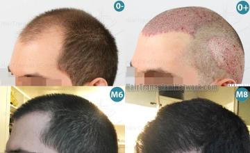  before and after photos
