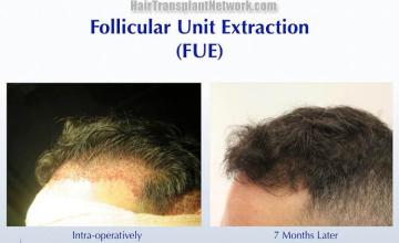 Hair transplantation surgery before and after photos