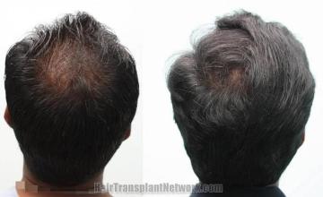 Hair transplantation surgery before and after pictures