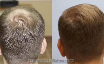 Hair restoration procedure before and after pictures