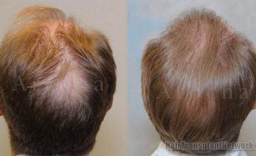 Back of head showing before and after hair replacement