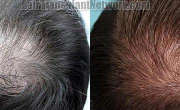 Before and after hair transplantation images