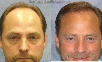  before and after photos front view
