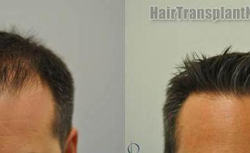 Before and after hair restoration result photographs