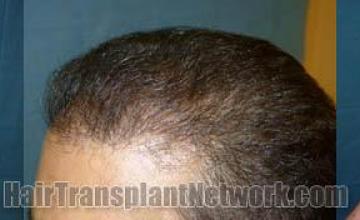 Hair transplantation before and after surgery