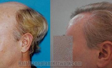 Hair restoration procedure before and after pictures