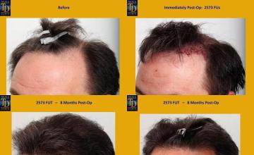 Hair transplantation surgery before and after pictures