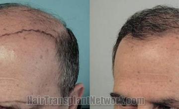 Hair transplantation surgery before and after images