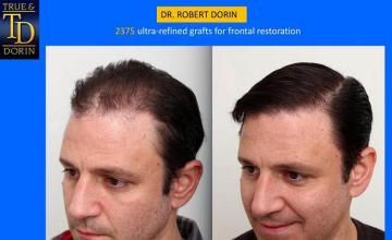 Hair transplantation surgery before and after images