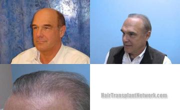 before and after photos