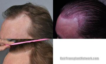 Hair restoration procedure before and after pictures