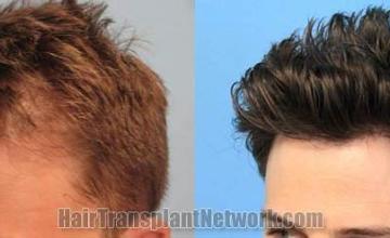 Hair transplantation surgery before and after pictures