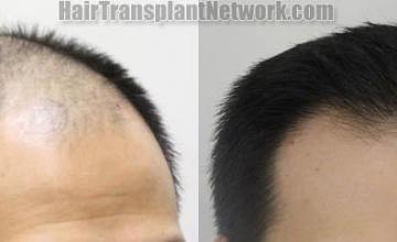 Hair transplantation surgery before and after images