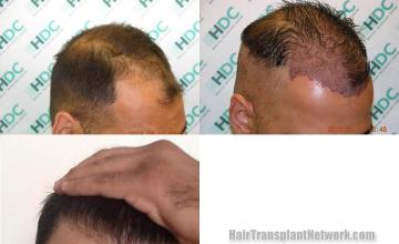 Hair transplantation surgery before and after pictures