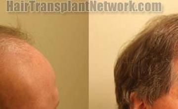 Hair transplantation surgery before and after images