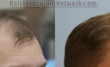  before and after images