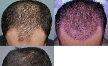 Top view before and after hair restoration results