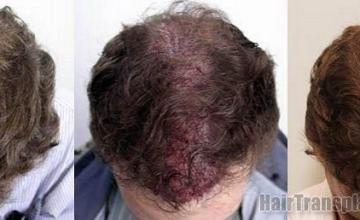 Hair transplant results viewing pictures from the top