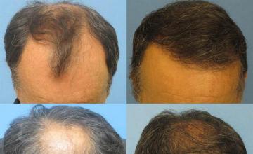 Hair restoration procedure with 4526 grafts before and after