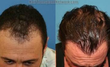 Top view - Before and after hair restoration photos