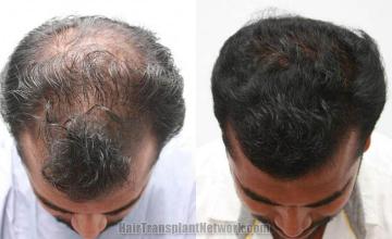 Top view - Before and after hair restoration procedure