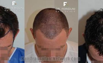 Top view before and after hair restoration results