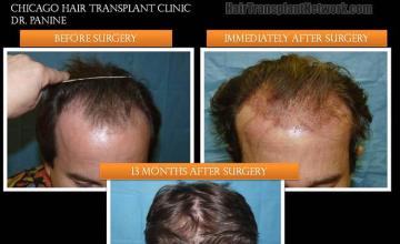 Top view before and after hair restoration results