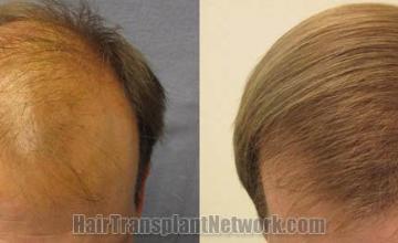 Top view before and after hair restoration results