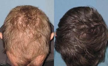 Hair transplantation surgery before and after pictures