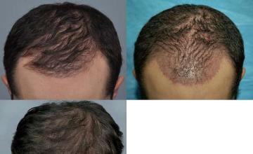 Hair transplantation surgery before and after images