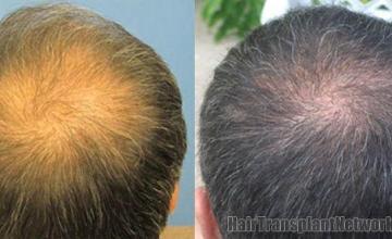 Photos of crown before and six months after hair restoration