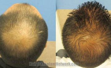 Photos of crown before and after hair transplant surgery