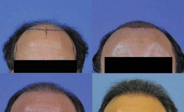 Hair transplant results front view
