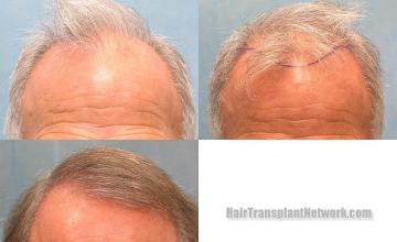 Hair restoration procedure before and after pictures