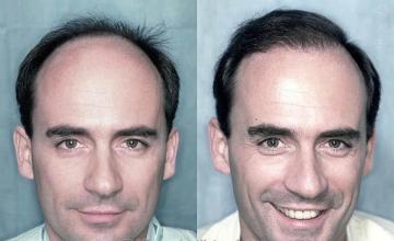  before and after images