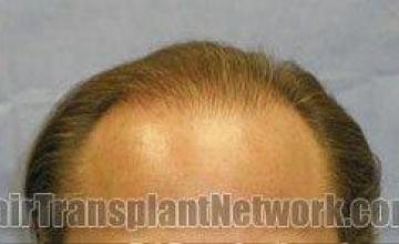 Hair restoration preoperative and postoperative pictures