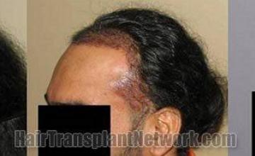 Hair restoration procedure results