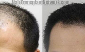 Hair transplantation surgery before and after pictures