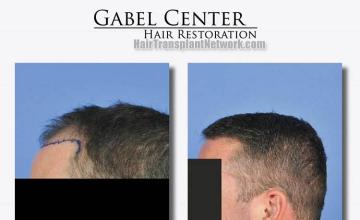 Hair transplantation surgery before and after images