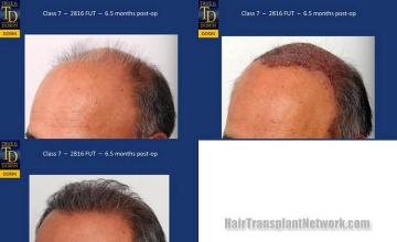 Hair transplantation surgery before and after images