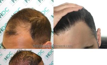 Hair restoration procedure before and after pictures