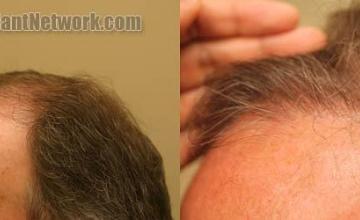 Hair transplantation surgery before and after pictures