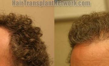 Hair transplantation surgery before and after photos