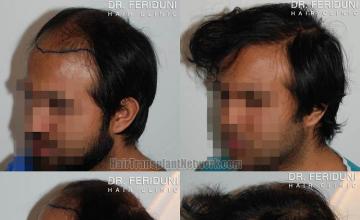 Hair transplantation surgery before and after images